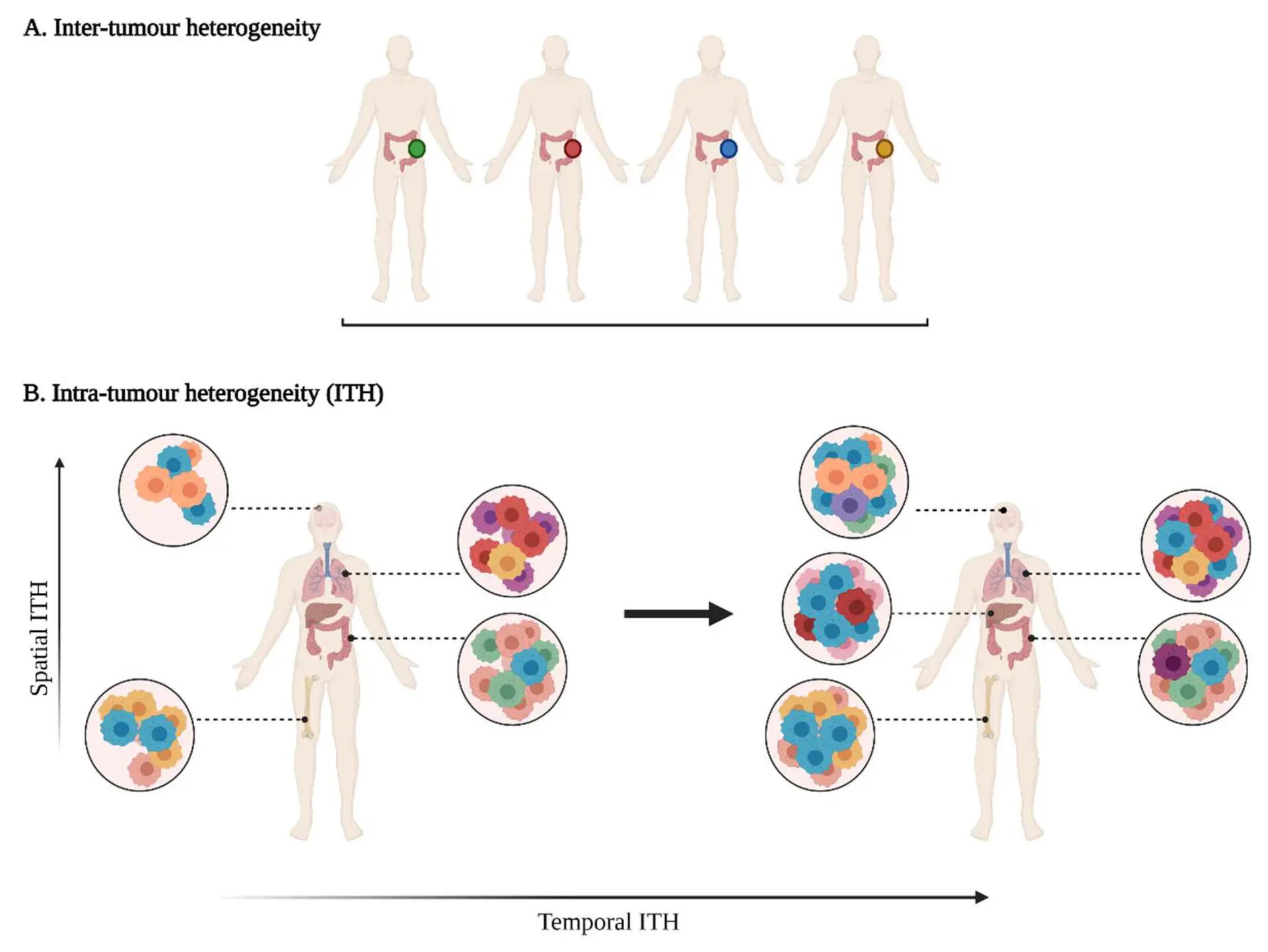 Tumor heterogeneity A multifaceted heterogeneity in cancers. (A) Inter-tumour heterogeneity refers to the variability observed in tumours of the same histological subtypes between different patients. (B) Intra-tumour heterogeneity (ITH) is observed across different regions of the primary tumour site and/or metastatic sites (spatial ITH) and can evolve over time (temporal ITH). Colours represent the different characteristics between tumours or tumour cells.